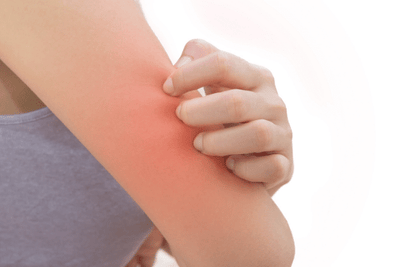 Best Allergy Antihistamine for Allergic Skin Rash?