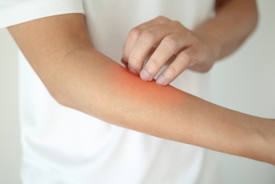 The Best Antifungal for Ringworm