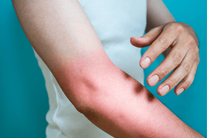 Sun Allergies vs Sun Poisoning vs Solar Urticaria