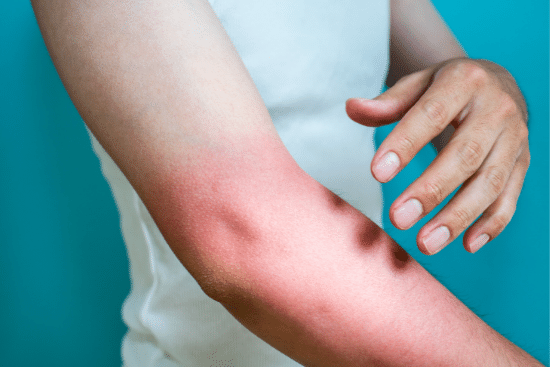 Sun Allergies vs Sun Poisoning vs Solar Urticaria