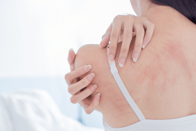 Best Antihistamines for Eczema